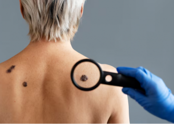 Melanoma Skin Cancer: Early Detection, Prevention, and Treatment