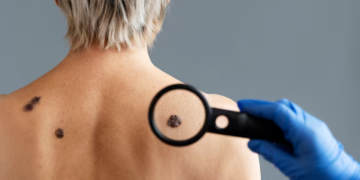 Melanoma Skin Cancer: Early Detection, Prevention, and Treatment