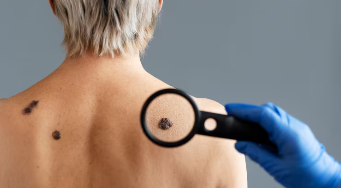 Melanoma Skin Cancer: Early Detection, Prevention, and Treatment